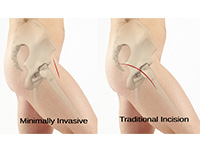 Minimally Invasive Approaches to the Hip