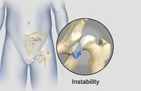 Hip Instability