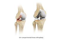 Non-surgical Treatment of the Knee