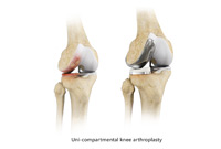 Minimally Invasive to Knee