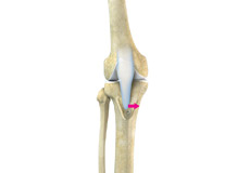 Patello-femoral Knee Replacement