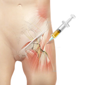 Platelet-Rich Plasma