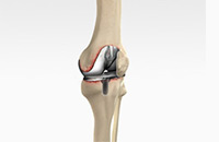  Revision Knee Replacement