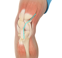 Minimally Invasive