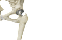 Total Hip Replacement THR