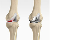 Uni condylar Knee Replacement