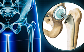 Revolutionizing Recovery: Same-Day Hip Replacement with Robotics